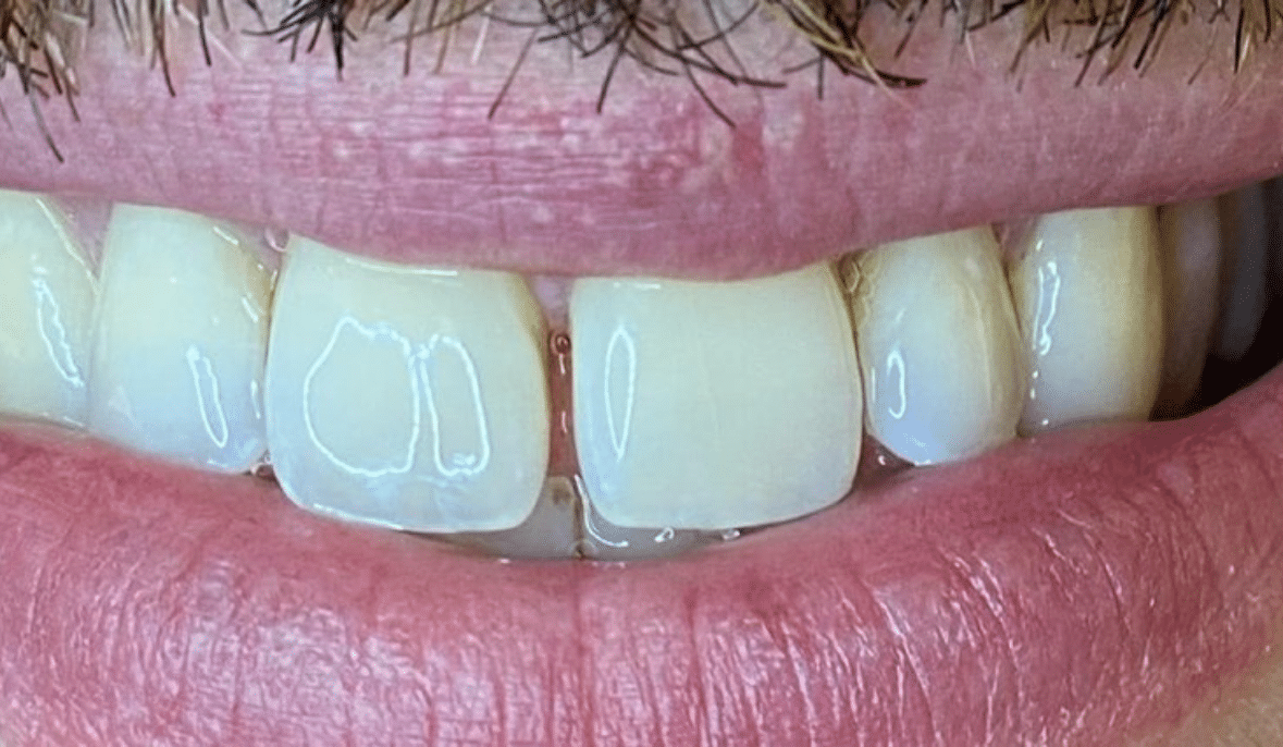 Before
